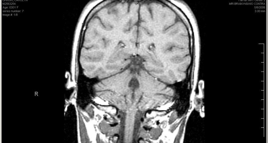 عکس MRI از مغز