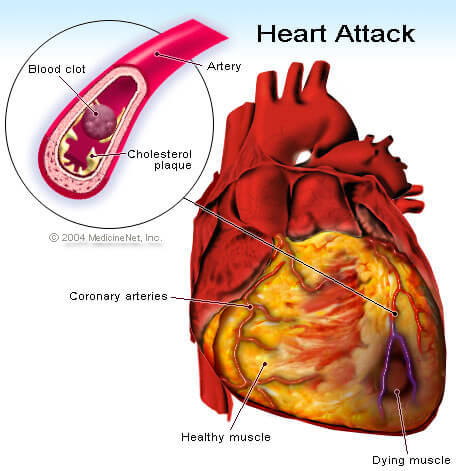 حمله ی قلبی 2 